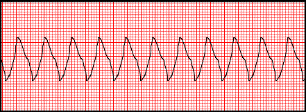v tach ekg